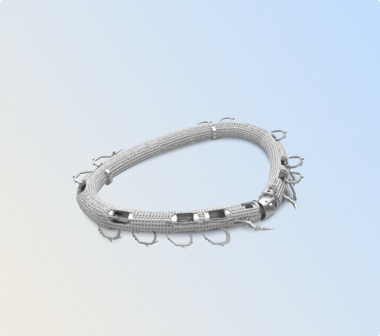 A rendering of the implanted ring
